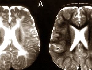 Healthoolzellweger syndrome photos | Healthool