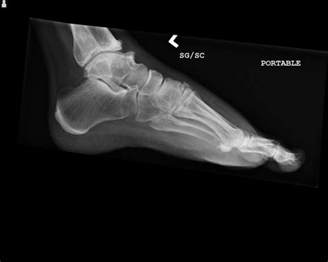 Ortho Dx: What is the best treatment for this foot injury? - Clinical Advisor