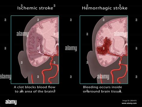 Ischemic & Hemorrhagic Stroke, Illustration Stock Photo - Alamy