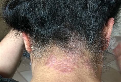 Please help me with this behind my neck and hairline eczema ...