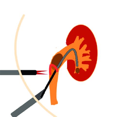 Schematic view of laparoscopic pyelolithotomy combined with flexible ...