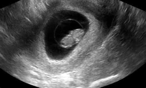 8 Week Pregnancy Ultrasound - IYTmed.com