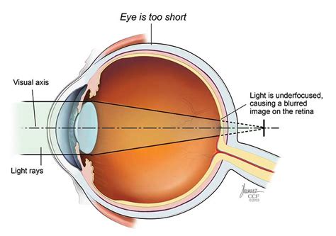 Farsightedness: Symptoms, Causes & Treatment