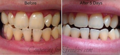 Smile Brilliant Teeth Whitening Tray Review