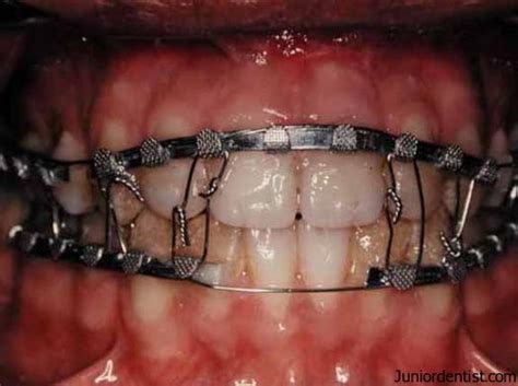 What is Dental Splinting Types, Objectives, Indications and Contraindications Of Splinting