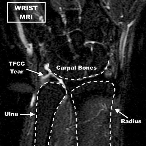 Tfcc Tear Mri - Goimages Inc