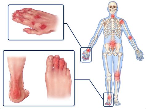 Tratamentul artritei psoriazice