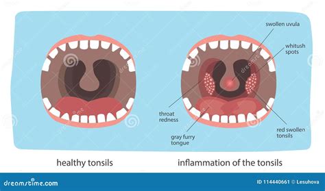 Healthy Tonsil Diagram