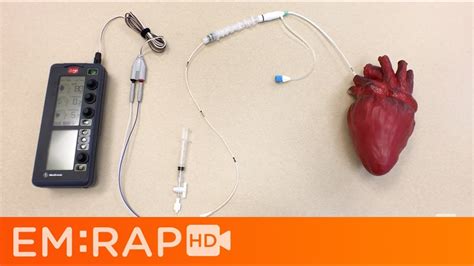 transmission Diacritical Strait transvenous pacing settings funnel Sui Grafting