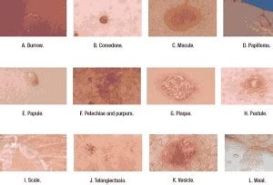 Skin Lesions - Sydney Cosmetic Specialists