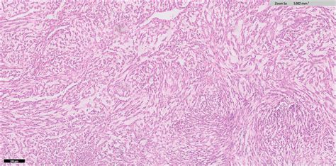 -Microscopic pathology of the mucinous tubular and spindle cell ...