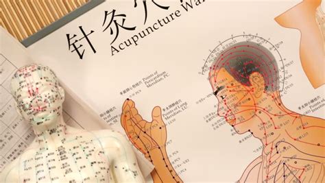 Acupuncture Stock Footage Video - Shutterstock