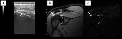 A Usg Showing Grade I Full Thickness Tear Of Supraspinatus Tendon | Images and Photos finder