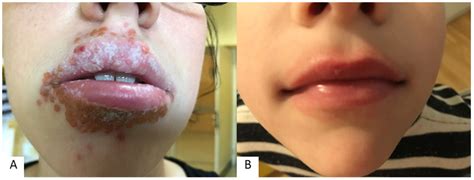 What Is Perioral Dermatitis? Symptoms, Causes, Diagnosis, Treatment, and Prevention, pregnancy ...