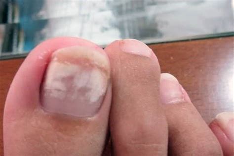 How Do I Get Rid Of White Marks On My Toenails ️