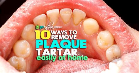 10 Easy Ways to Remove Plaque and Tartar from Teeth At Home Naturally ...