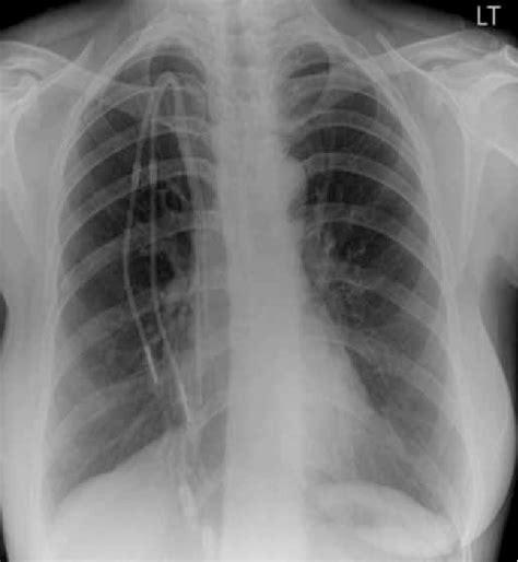 Figure 2 from The S-Tunnel for Tunnelled Dialysis Catheter: An Alternative Approach to the ...