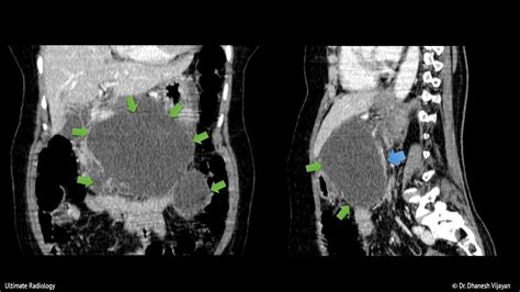 Ultimate Radiology : Pancreatic pseudocyst with duct communication (CT)