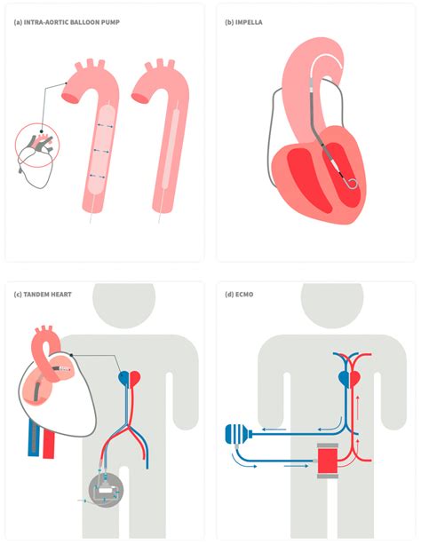 JCM | Free Full-Text | Mechanical Circulatory Support Devices for the Treatment of Cardiogenic ...