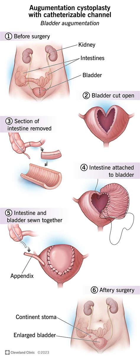 Bladder Augmentation (Cystoplasty): Procedure & Recovery