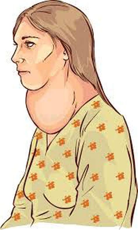 Symptoms of goiter - MEDizzy