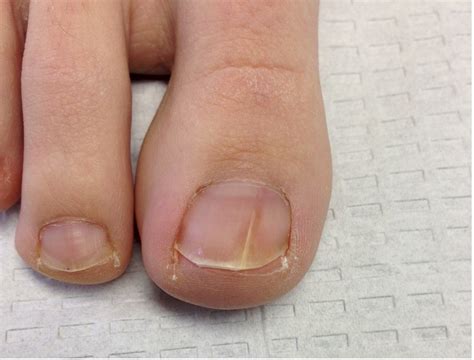 Topical Antifungal Medications | Which medication is right for your toe ...