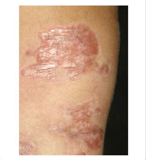 Aspect of atrophic scars at the end of the treatment. | Download ...