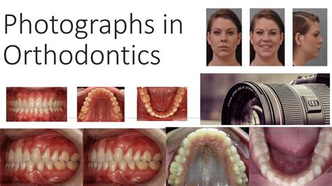 Photographs in Orthodontics - Orthodontics - YouTube