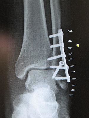 Fibula fracture surgery | General center | SteadyHealth.com