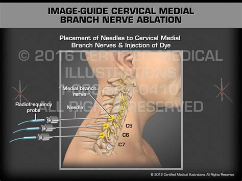 Nerve Block Procedure In Neck - wallpaperbotfly