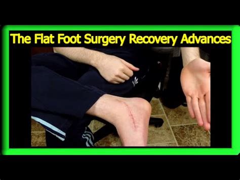 Flat Foot Surgery Recovery: Weeks 7-9 - YouTube