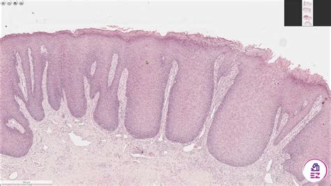 Chronic Hyperplastic Candidiasis - YouTube