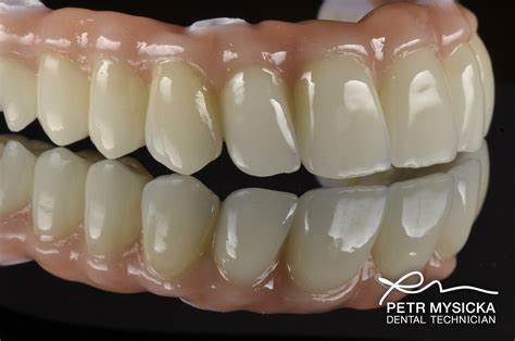 Zirconia All on 4 Bridge - Brighton Implant Clinic : Dental Implants