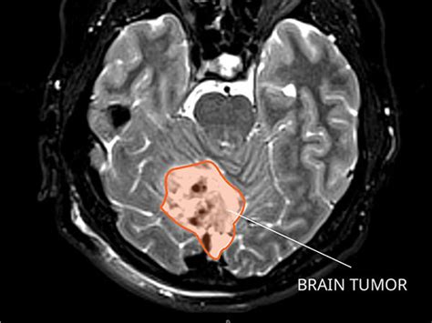 Medulloblastoma Diagnosis and Treatment - NCI