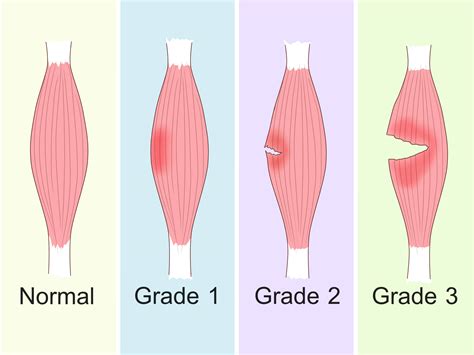 Quad Strain: Symptoms, Treatment, and Prevention