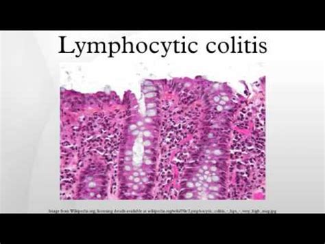 Lymphocytic colitis - YouTube