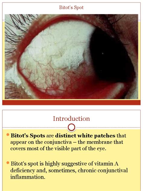 Bitot's Spot | PDF | Vitamin A | Vitamin