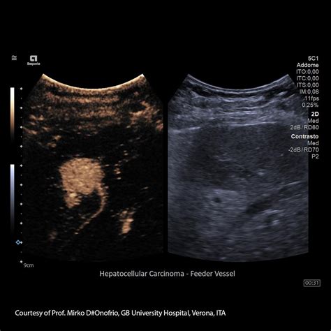 Liver Cancer: From diagnosis to personalized treatment