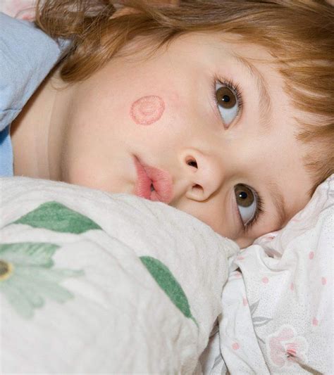 Ringworm In Kids: Types, Causes, Symptoms, Treatment & Care