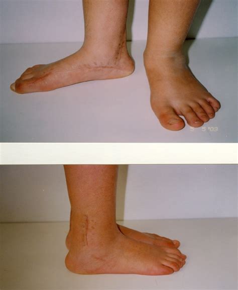 Split tendon transfers for the correction of spastic varus foot deformity: a case series study ...