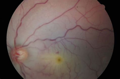 Traumatic Optic Neuropathy and Central Retinal Artery Occlusion Following Blunt Ocular Trauma ...