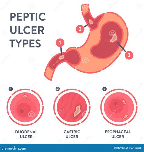 Types of Peptic Ulcer Stomach Disease Infographics Stock Vector - Illustration of disease ...