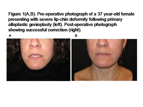 AAPS - AAPS 2011 Annual Meeting Abstracts: CORRECTING LIP-CHIN DEFORMITIES AFTER OSSEOUS AND ...