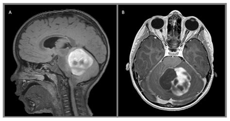 Juvenile pilocytic astrocytoma, WHO 1: (A) sagittal T2 FLAIR with... | Download Scientific Diagram