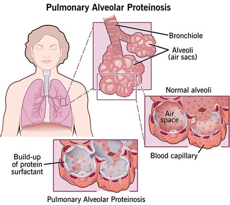 Pulmonary alveolar proteinosis causes, symptoms, dignosis, treatment ...