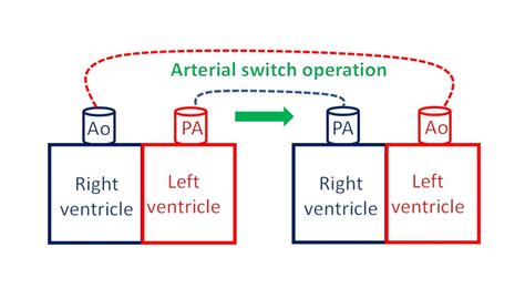 What is transposition of great arteries (TGA)? – All About Heart And Blood Vessels