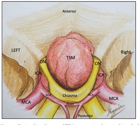 Figure 1 from Skull Base Approaches for Tuberculum Sellae Meningiomas ...