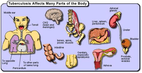 Tuberculosis: Contraction, Diagnosis, Treatment | Online Homework Help | SchoolWorkHelper