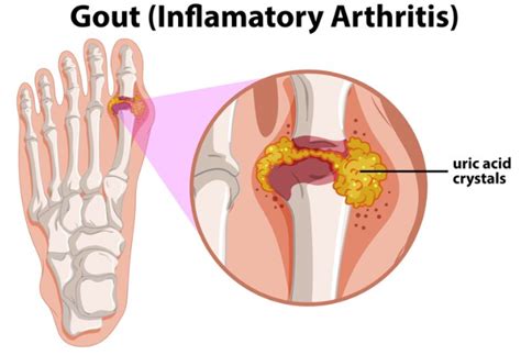 Does Foot Massage Help Gout? Symptoms And Management