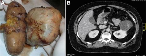 (A) Kidney and complex cyst, macroscopic appearances. (B)... | Download ...